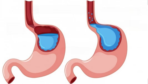 胃反酸往上反酸水是怎么回事？用铝碳酸镁可缓解反酸