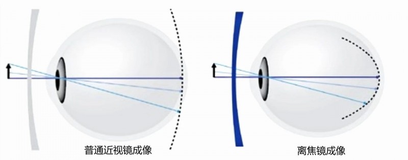 北京爱尔英智眼科医院唐琰为您讲解：离焦镜真的可以延缓近视进程吗？